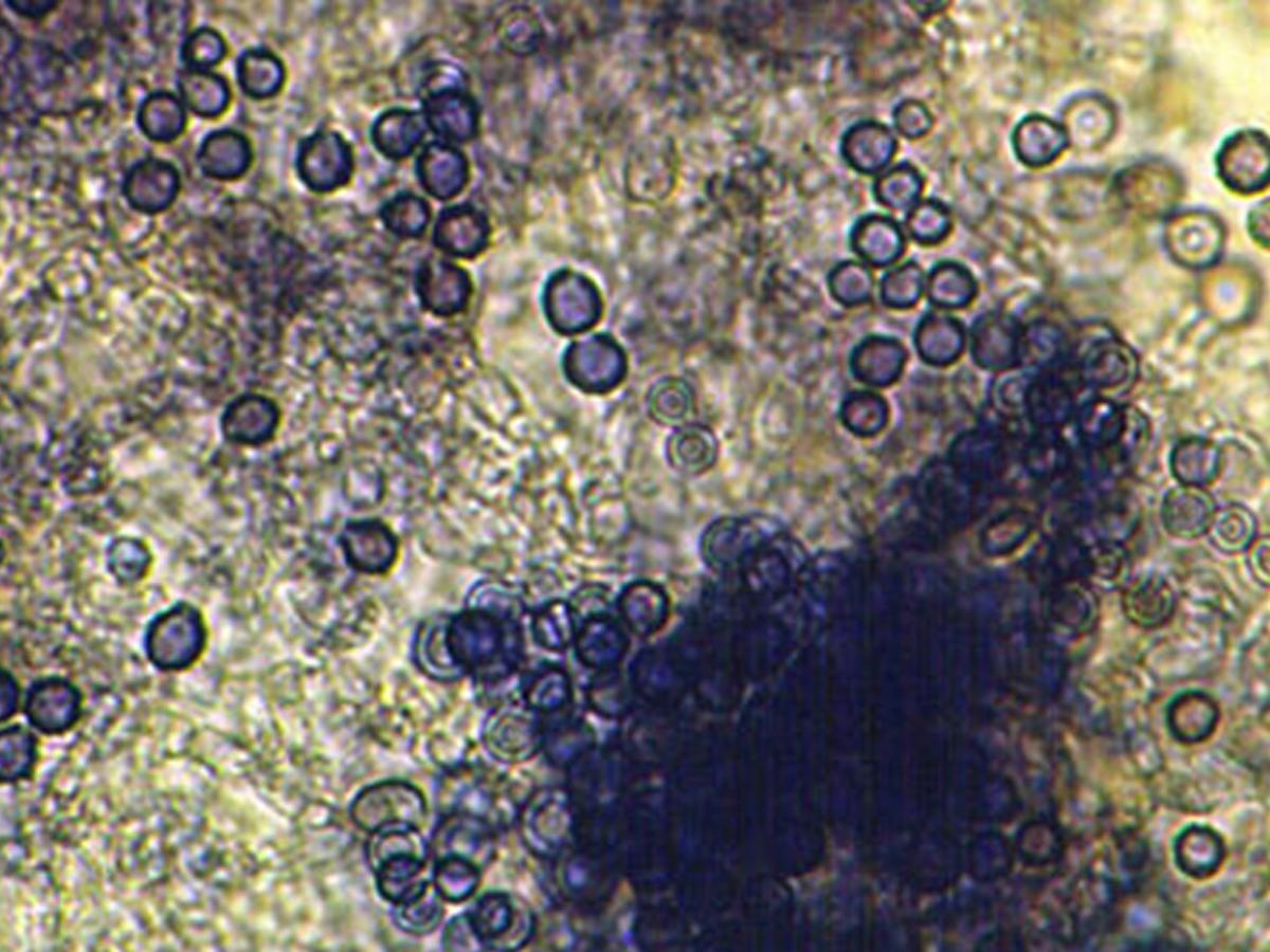 Unknown 56 direct microscopy (KOH mount)