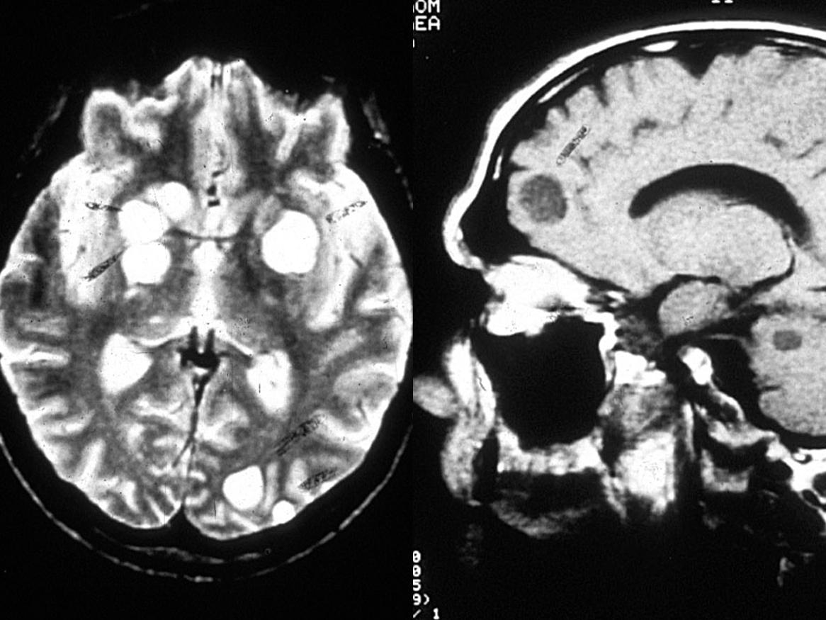 Opportunistic Systemic Mycoses
