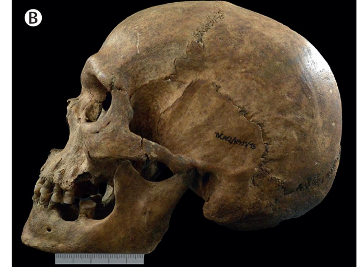 A side-on photo of a 1000 year old skull diagnosed with Klinefelter's syndrome.