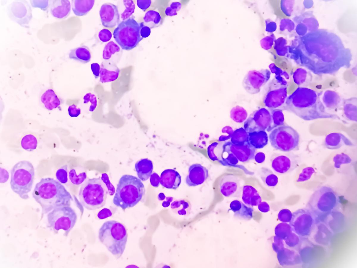 Image of multiple myeloma from under a microscope.