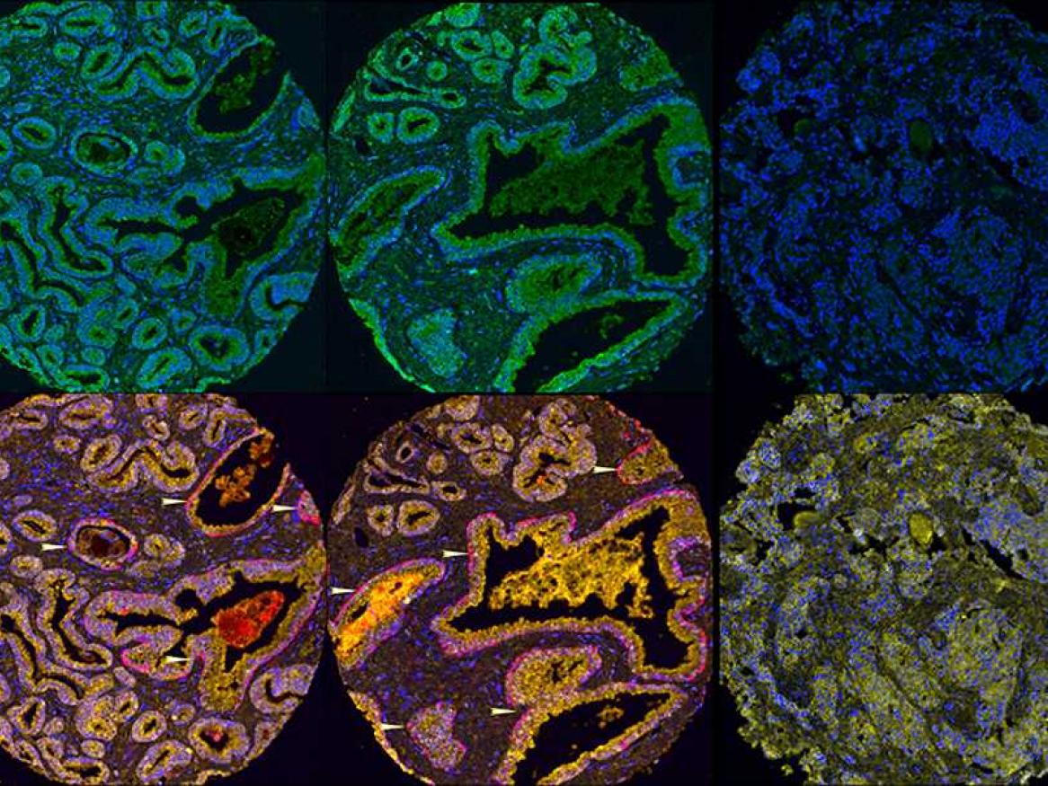 Staining of proteins in prostate cancer